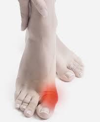 hogyan kell kezelni a hallux valgus t)