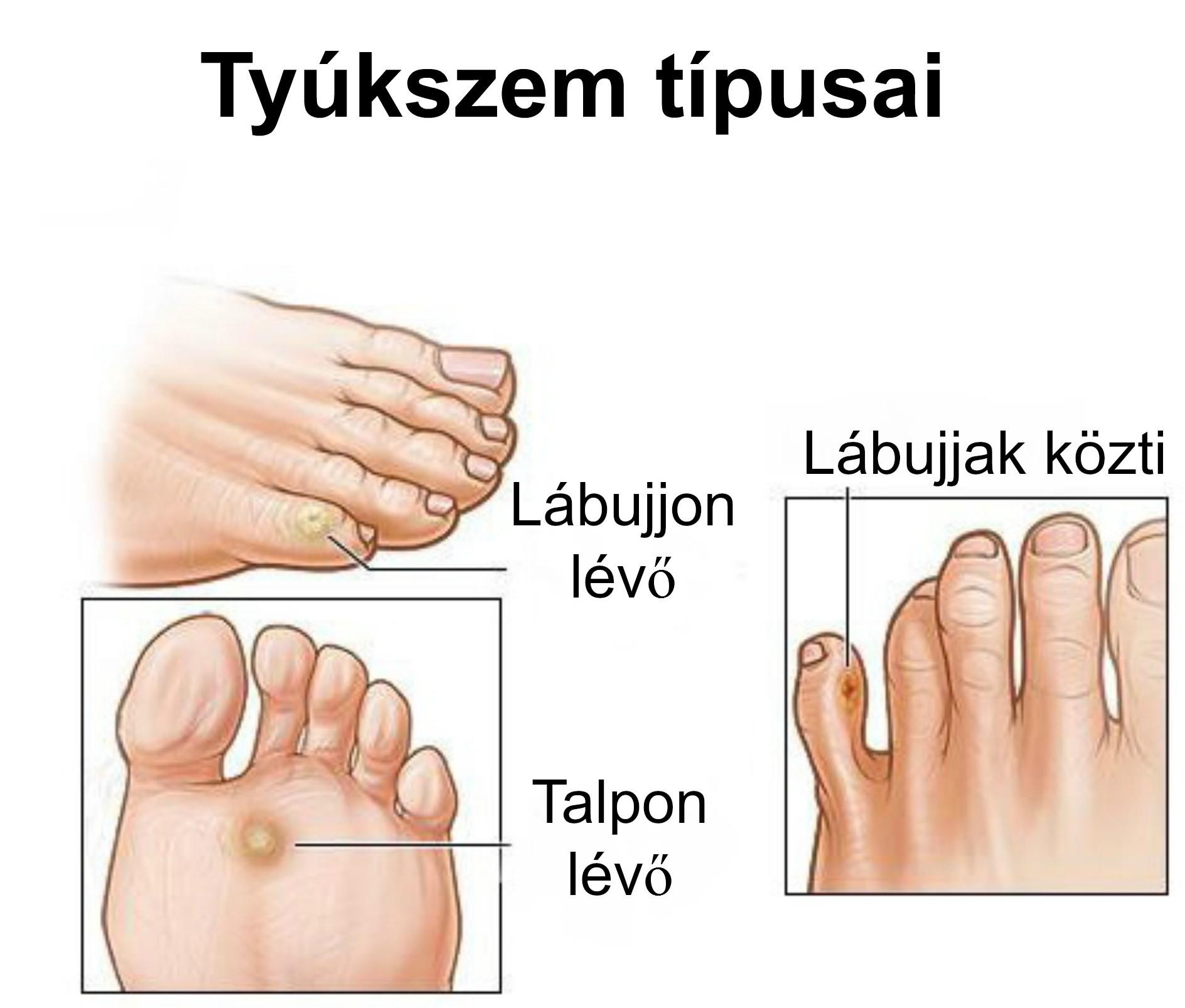 a tyúkszem kezelése a lábujjak ízületein gyógyszerek az ujjak ízületeinek gyulladására
